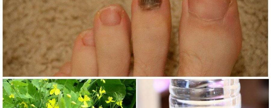 4 проверенных средства от грибка ногтей на ногах